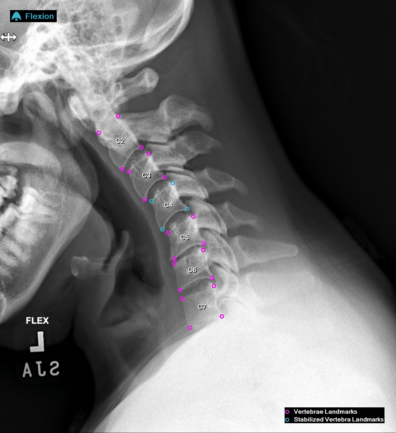 Cervical flexion and extension X-ray with C4 stabilized